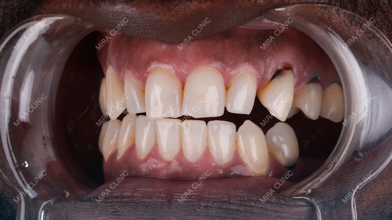 Impacted Molars, Decay, and Tooth Loss